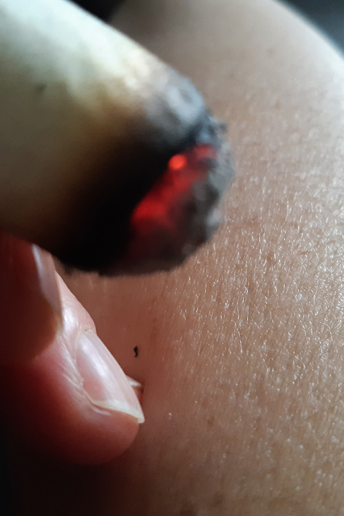 Moxibustion